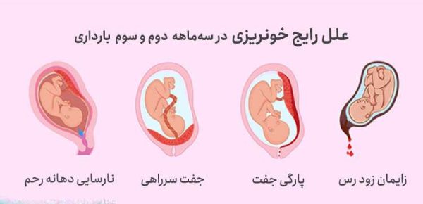 علت خونریزی یا لکه بینی در سه‌ماهه اول بارداری