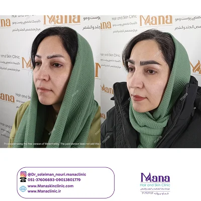 قبل و بعد  کاشت ابرو