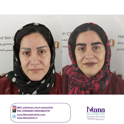 قبل و بعد  کاشت ابرو