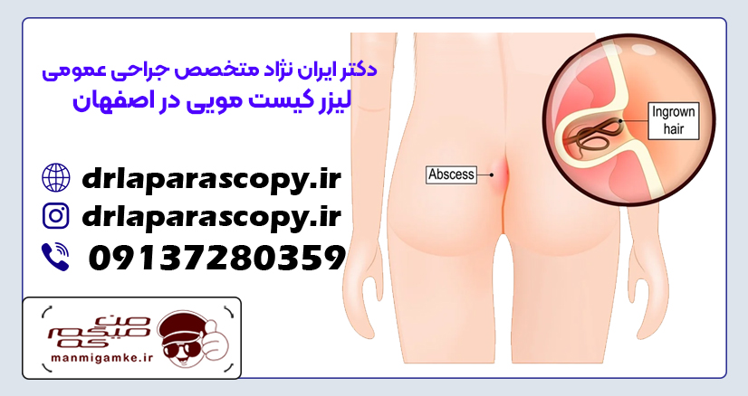 بهترین دکتر کیست مویی در اصفهان کیست