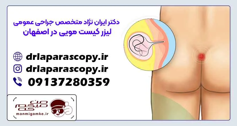 بهترین دکتر کیست مویی در اصفهان کیست