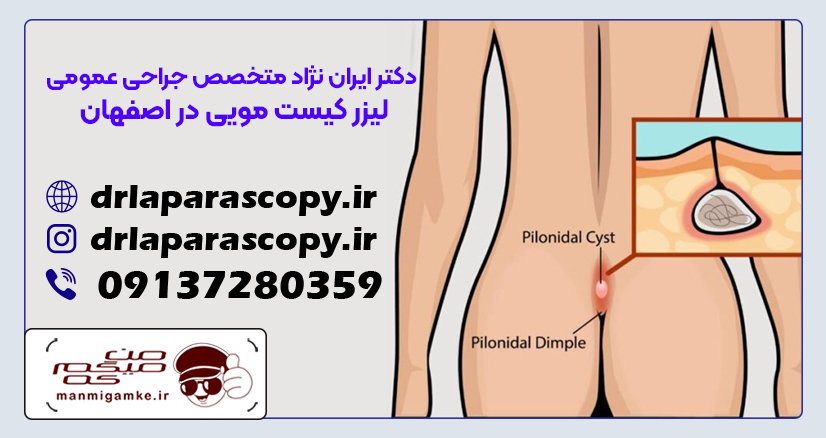 بهترین جراح کیست مویی در اصفهان