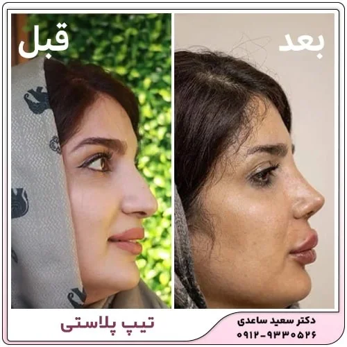 تفاوت رینوپلاستی و تیپ پلاستی در چیست؟
