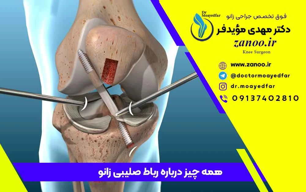  عمل جراحی رباط صلیبی زانو