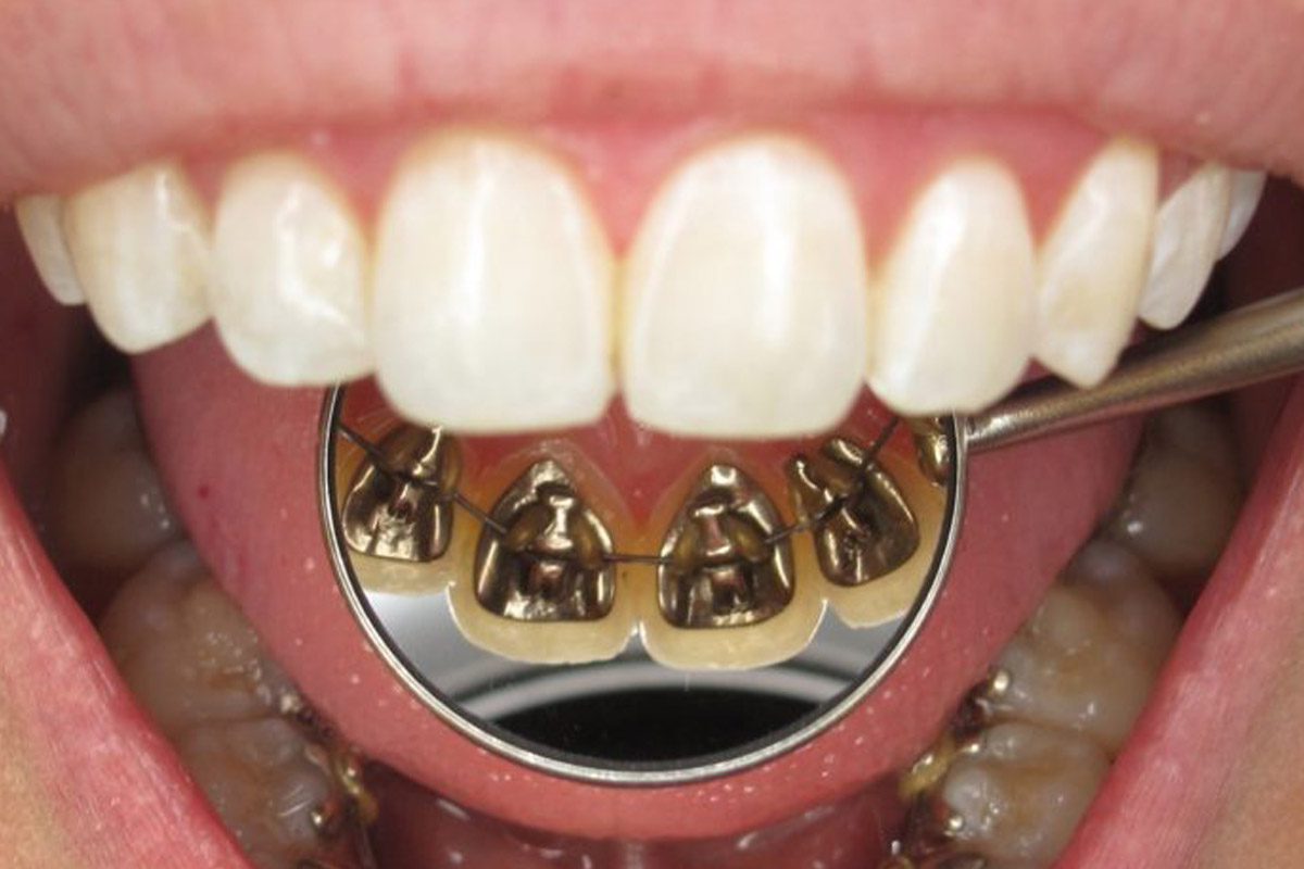 معایب ارتودنسی نامرئی یا پشت دندانی