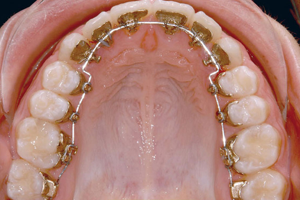 ارتودنسی لینگوال