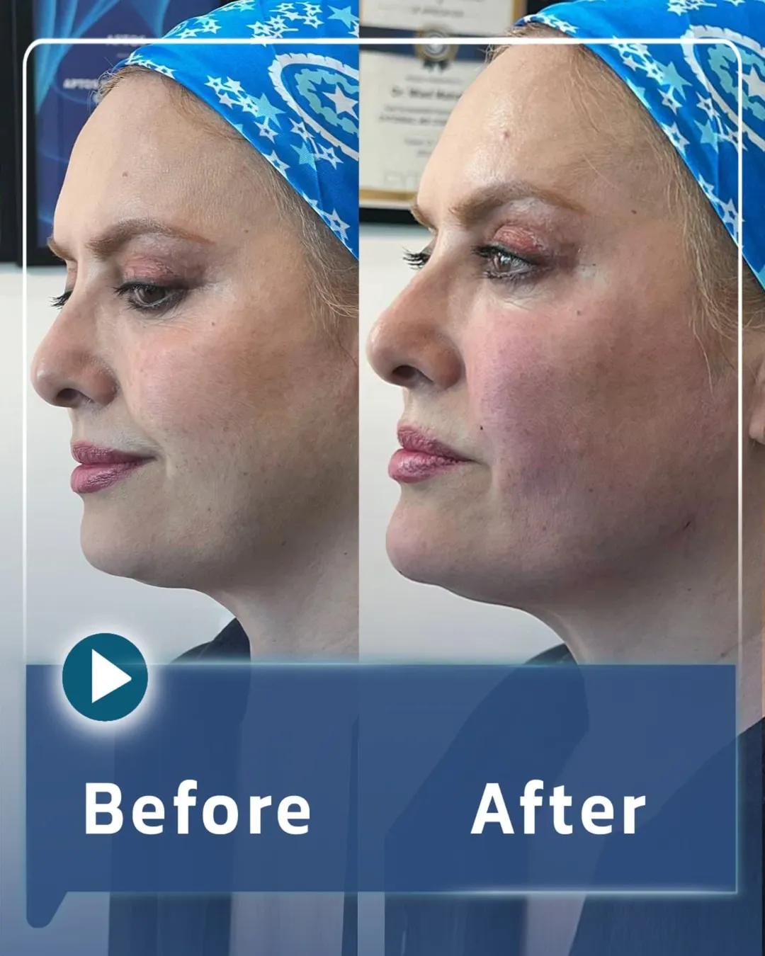 تزریق ژل عکس قبل و بعد از کانتورینگ صورت با فیلر