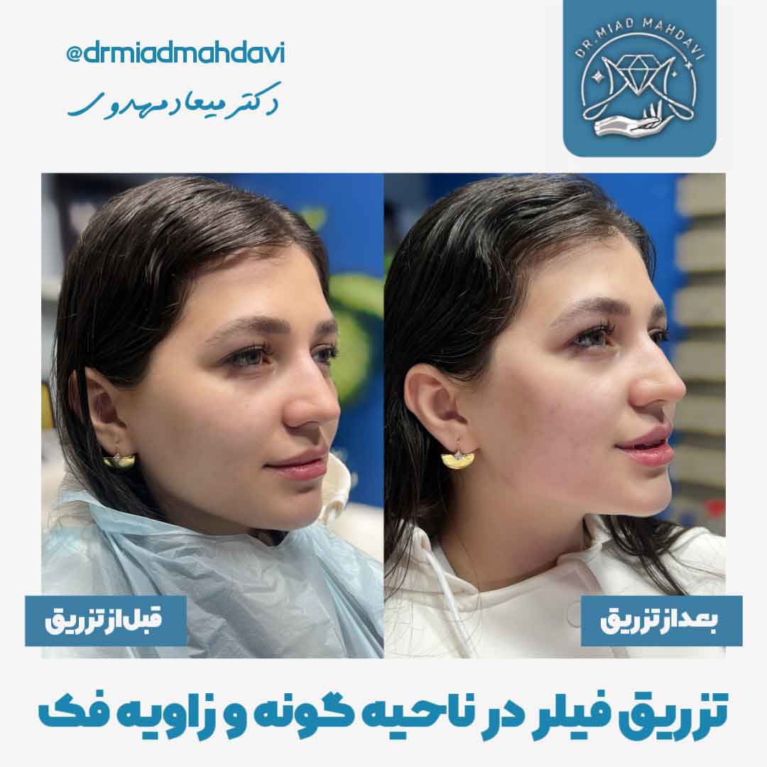 تزریق ژل کانتورینگ صورت دکتر میعاد مهدوی