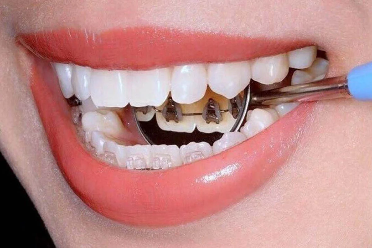 ارتودنسی نامرئی چیست؟ چگونه انجام می‌شود و چه مزایا و معایبی دارد؟
